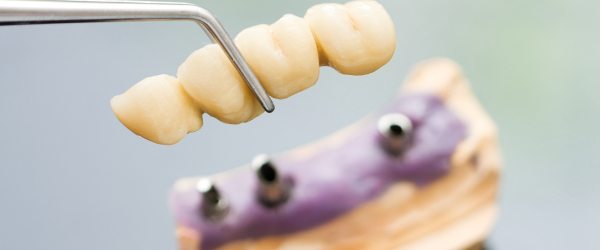 Three main reasons why you should upgrade your dentures to dental implants