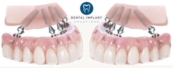 Upgrade your Denture or Replace Failing Teeth with All-On-4 Dental Implants
