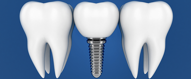 what causes tooth loss Gold Coast Dental Implants