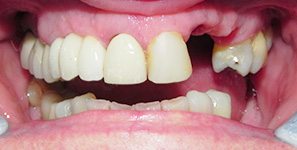 dental restoration