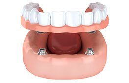 two dental implants