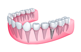 What is a single tooth implant?