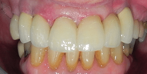 single tooth implant after