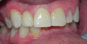 Single Tooth Implants image